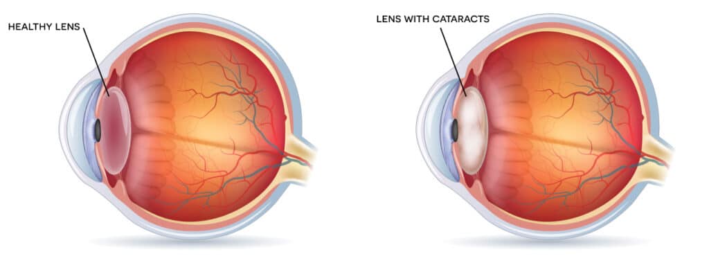 Chart illustrating a healthy lens compared to one with cataracts