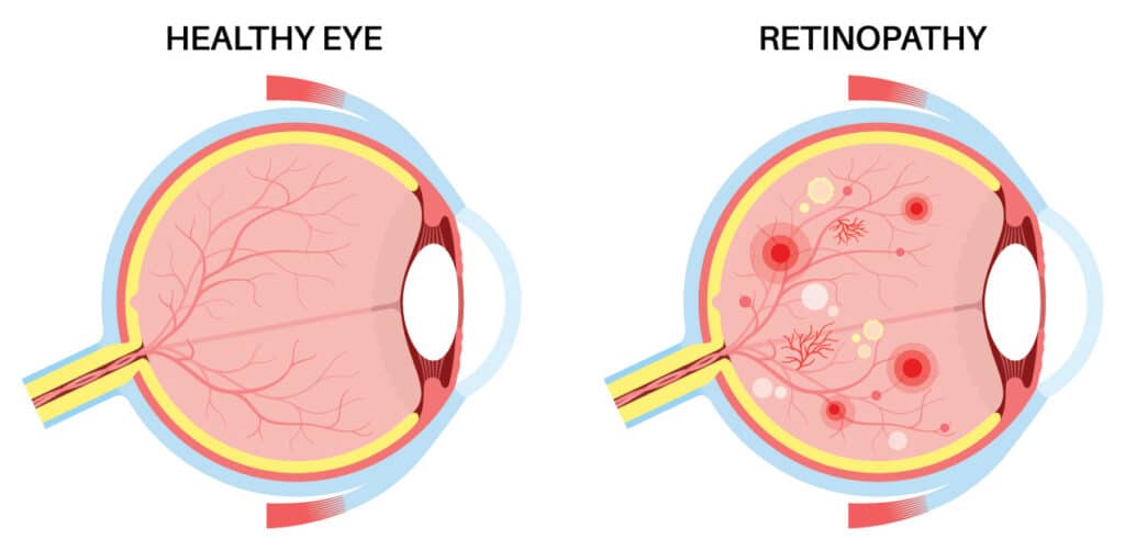 Chart illustrating a healthy eye compared to one with diabetic retinopathy