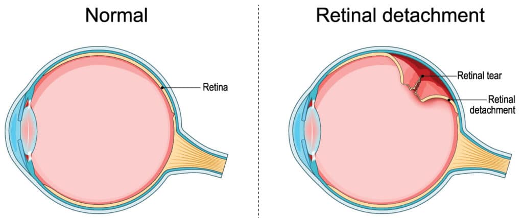 Chart Illustrating a Normal eye compared to one with a retinal detachment/tear